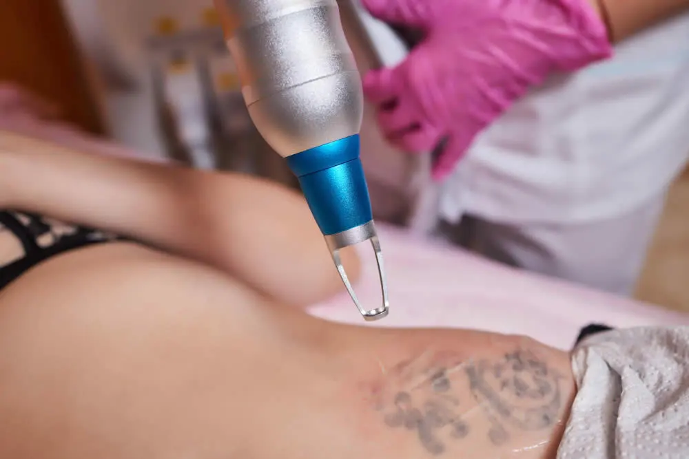 laser-tattoo-removal-procedure-dermatologist